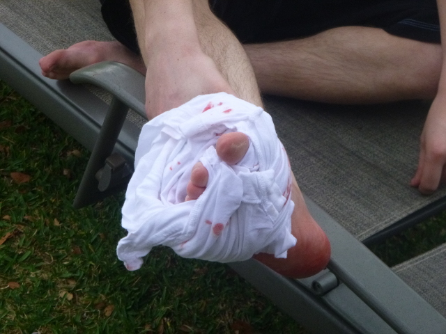 An injured foot wrapped in a t-shirt.